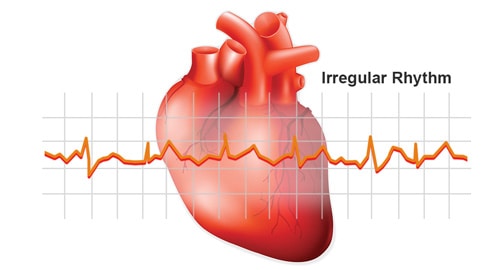 Irregular Rhythm