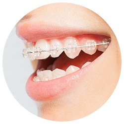 Ceramic Braces