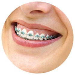 Conventional Metal Braces