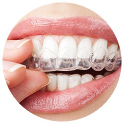 Invisalign