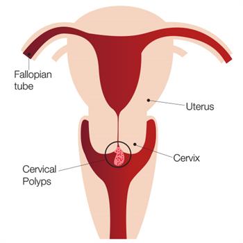 Cervical Polyps affecting the cervix in a woman