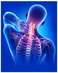 Cervical spondylosis involved the wear and tear of cartilage in your neck