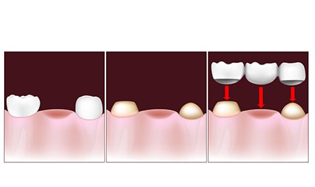 illustration of crowns implant