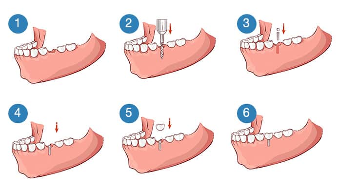 6 steps - overview of a dental implant procedure