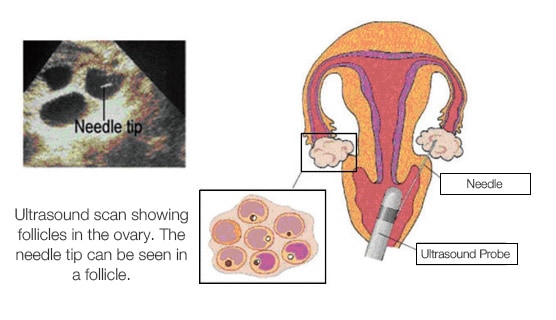 Ultrasound scan showing follicles in the ovary. The needle tip can be seein in a follicle