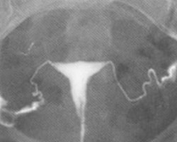 Ultrasound Scan of Fertility Tests and Treatments