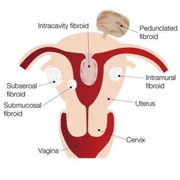 Uterine Fibroids in female reproductive system