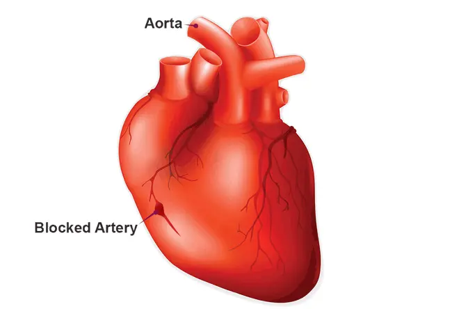 A heart bypass surgery, or a coronary artery bypass surgery (CABG)