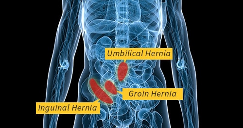 3 main types of hernia: umbilical hernia, groin hernia, inguinal hernia