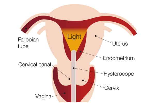 How a Hysteroscopy Works