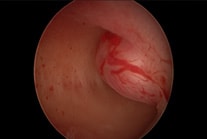 Hysteroscopy: Submucous fibroid bulging into the uterus cavity