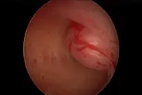 Hysteroscopy: Submucous fibroid bulging into the uterus cavity