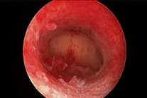 Hysteroscopy: Normal uterus cavity