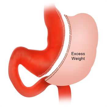 excess weight is removed from stomach