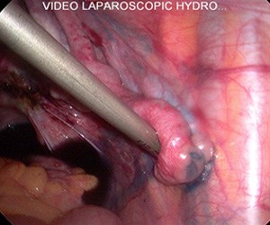 Laparoscopy: showing dye flowing out the fallopian tube