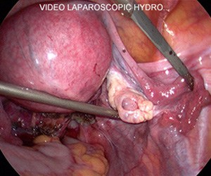 Laparoscopy: showing dye flowing out the fallopian tube