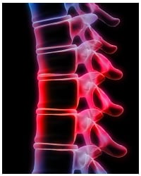 Degenerative arthritis affects the spine