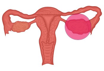 Fluid-filled sacs in the ovary