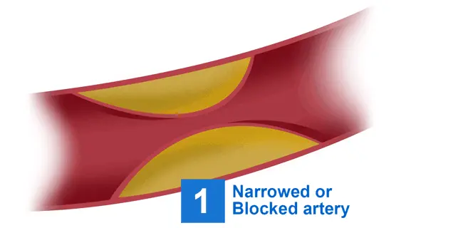 Animation of artery