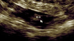 Transvaginal Ultrasound scans of the ovary showing antral follicles