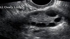 Transvaginal Ultrasound scans