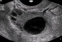 Transvaginal Ultrasound scans of the ovary showing dominant follicle image 1