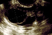 Transvaginal Ultrasound scans of the ovary showing dominant follicle image 2