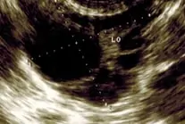 Transvaginal Ultrasound scans of the ovary showing dominant follicle image 3