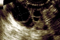 Transvaginal Ultrasound scans of the ovary showing dominant follicle image 4