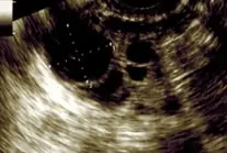 Transvaginal Ultrasound scans of the ovary showing dominant follicle image 4