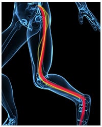 Irritation of sciatic nerve in the lower back