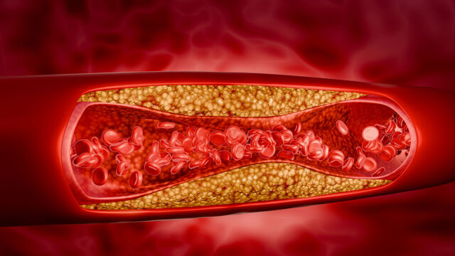 LDL Cholesterol Managing the Bad Cholesterol