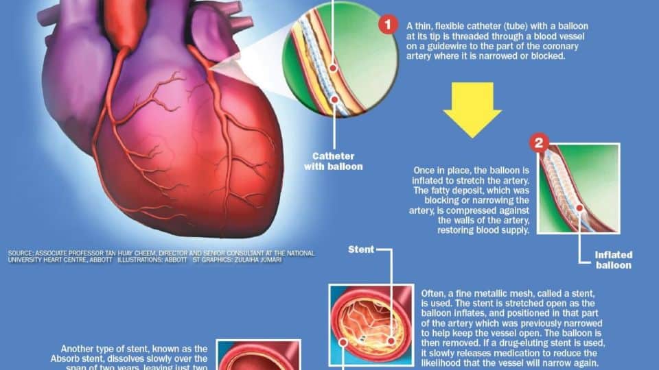 Smart Stents