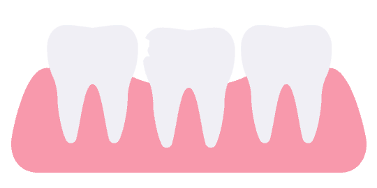 Broken and chipped tooth