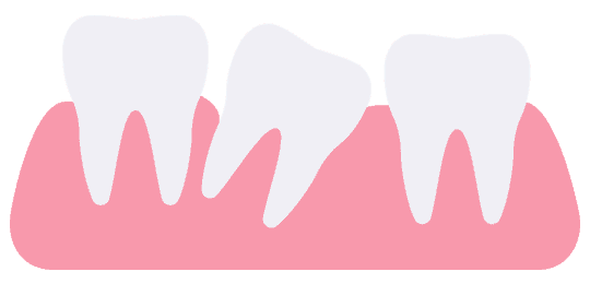 Misaligned teeth