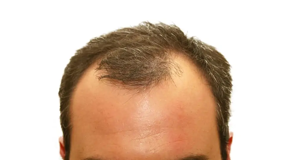 grey-hair-loss