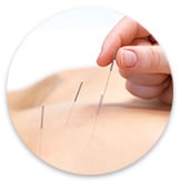 Acupuncture