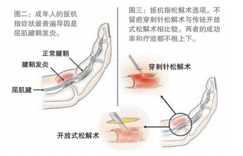 扳机指：不可忽略的手部保健