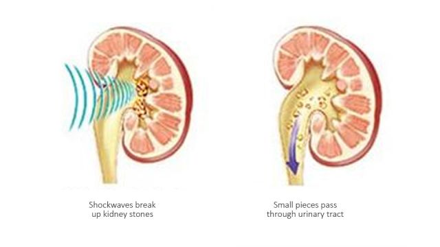 EWSL procedure