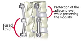 hybrid fusion spinal fusion technique