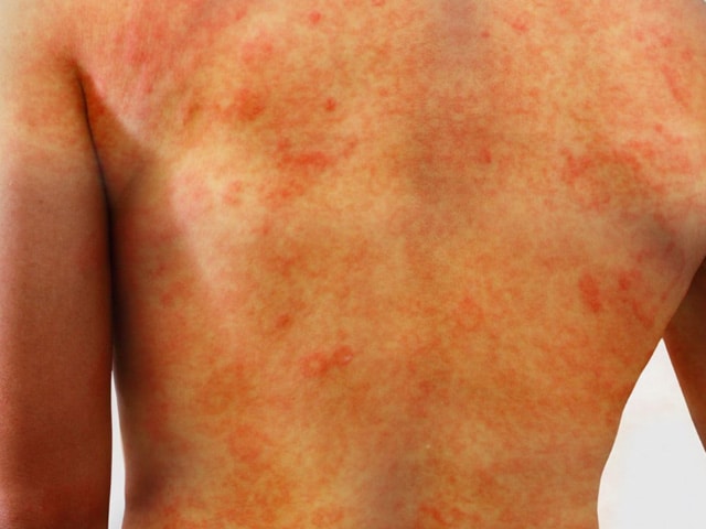 raffles medical - vaccination for measles mumps and rubella