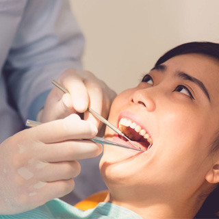 Dental Fillings