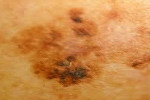 Melanoma