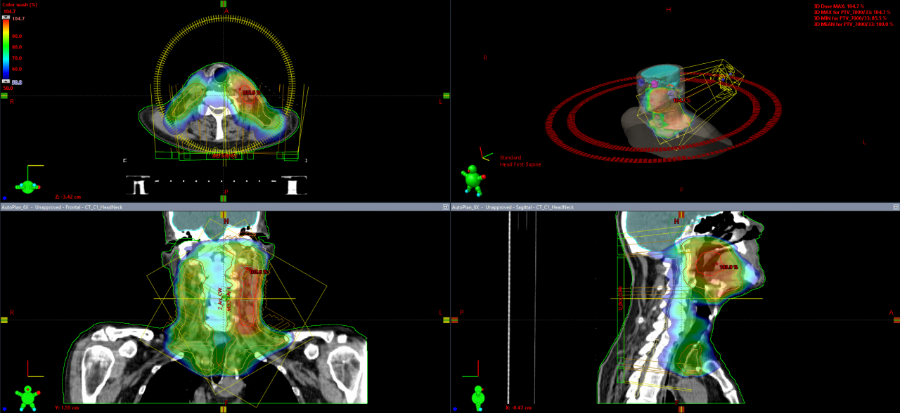 Radiotherapy treatment plan