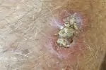 SCC