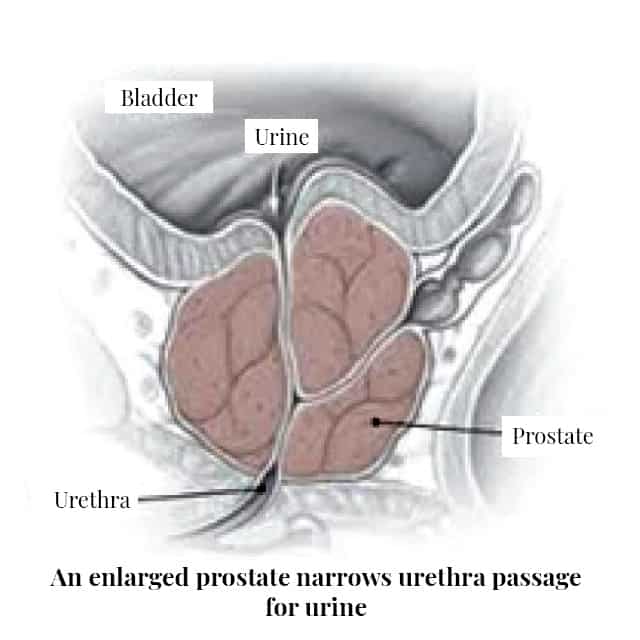 UTI for Female