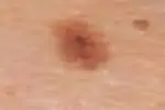 Naevus