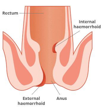 haemorrhoid can appear internally or externally