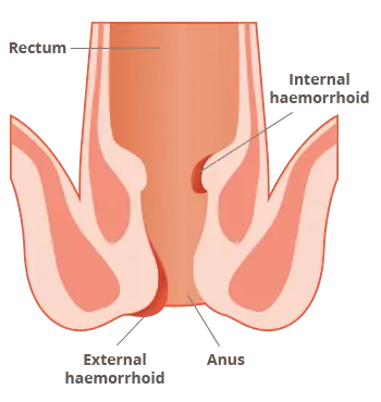 haemorrhoid can appear internally or externally