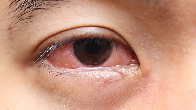 Red eyes cause by conjunctivitis